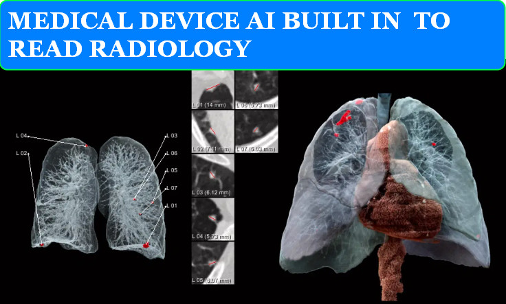 MEDICAL DEVICE AI BUILT IN TO READ RADIOLOGY
